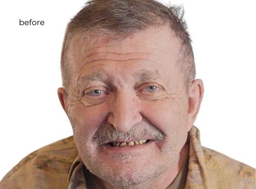 Dental Implants In Phoenix AZ Permanent Teeth In 24 Hrs dental-implants-in-phoenix-az-permanent-teeth-in-24-hrs